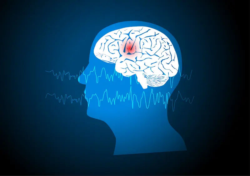What is Epilepsy Causes, Symptoms, and Modern Treatments